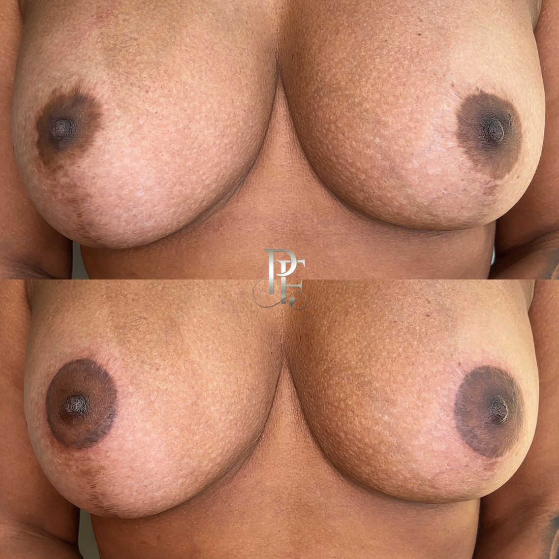 Camuflagem de cicatriz abdominal